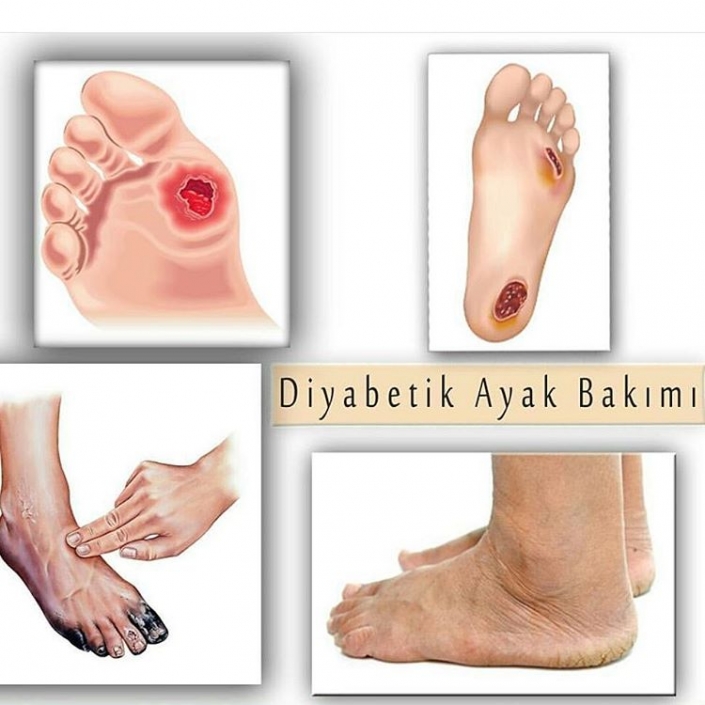 Diyabetik Ayak Nedir Diyabetik Ayak Bakımı Nasıl Yapılır Podiclinic